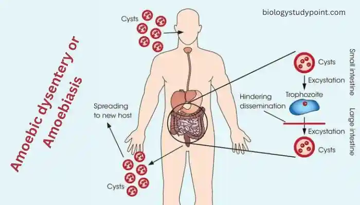 amoebiasis,