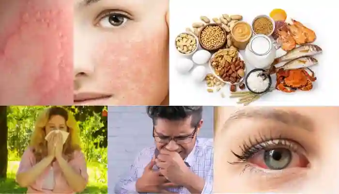 symptoms of allergies