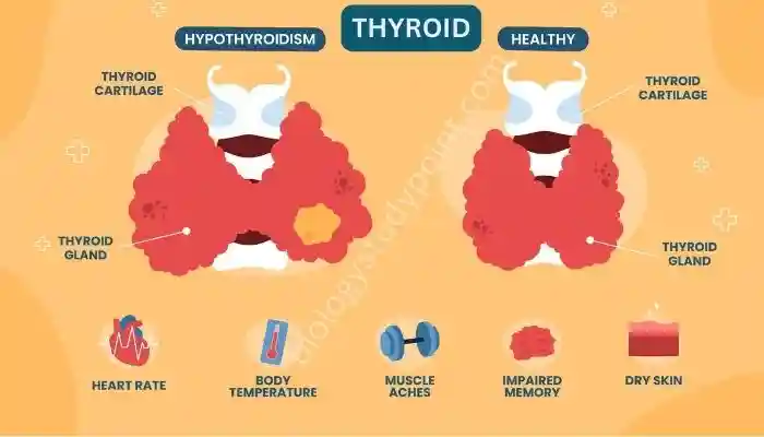 Thyroid